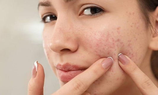 Home Remedy for Acne