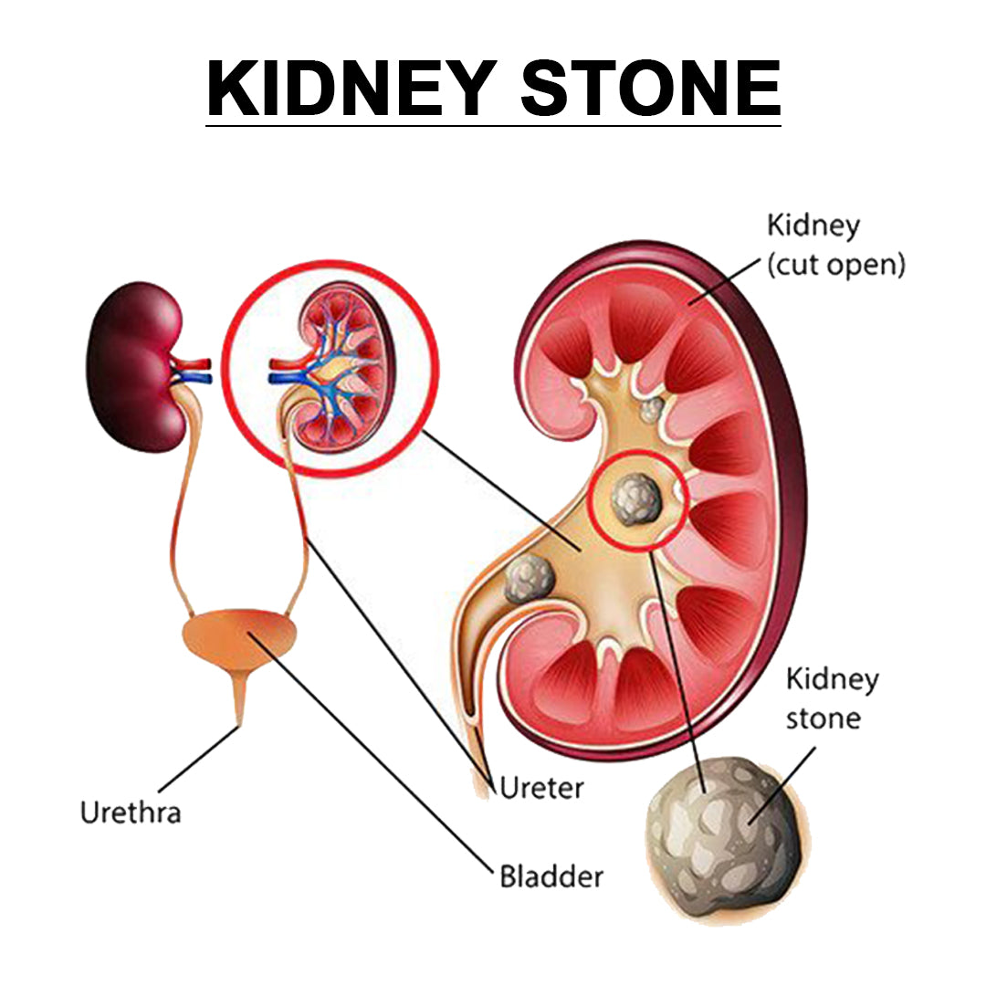 Nephrol Syrup Kidney stone Medicine sugar free