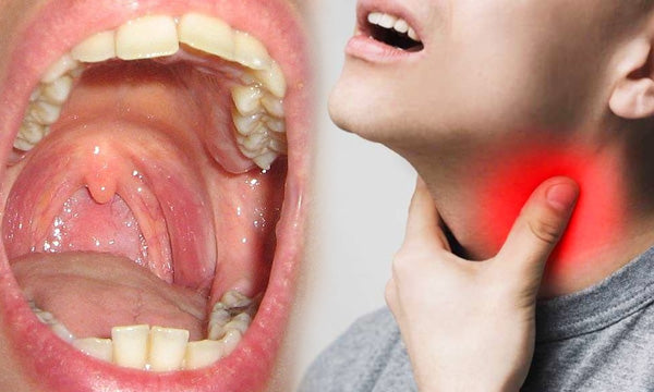 Home Remedy for Sore Throat