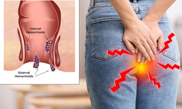 Symptoms of Piles