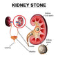 Nephrol Tablet for Urinary Health and Alleviate a Range of Urinary Conditions (1000 Tablets)