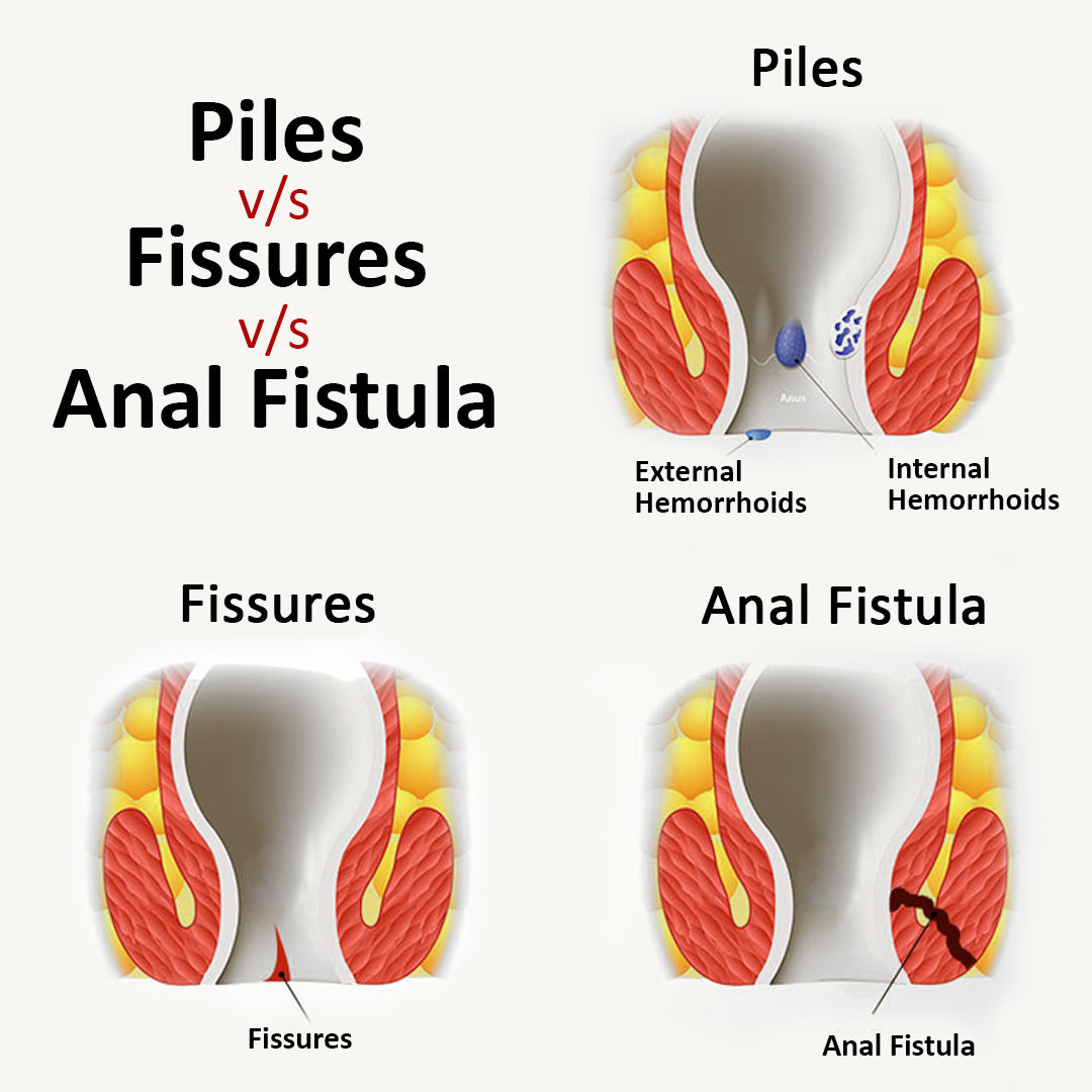 Piles & Fissure Kit